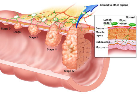 colorectal cancer in lymph nodes